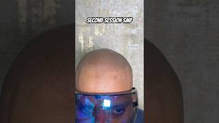 Second session scalp micropigmentation gives 50 results scalpmicropigmentationindia smp [upl. by Willie]